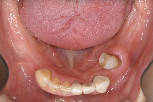 左下第二小臼歯の抜歯