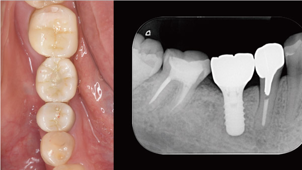 Ⅰ ．下の奥歯を虫歯で1本失った症例