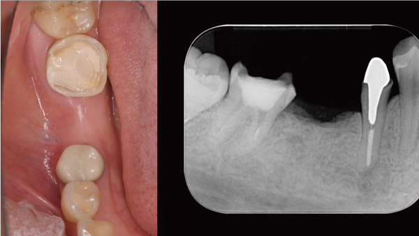 下の奥歯を虫歯で1本失った症例