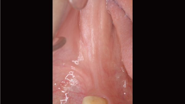 下の奥歯を3本失い入れ歯のバネが嫌でインプラント治療に移行した症例