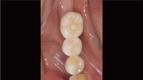 Ⅲ ．下の奥歯を3本失い入れ歯のバネが嫌でインプラント治療に移行した症例