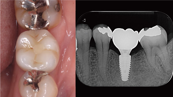 Ⅳ ．下の奥歯の根っこが膿んでしまい、抜歯に至った症例