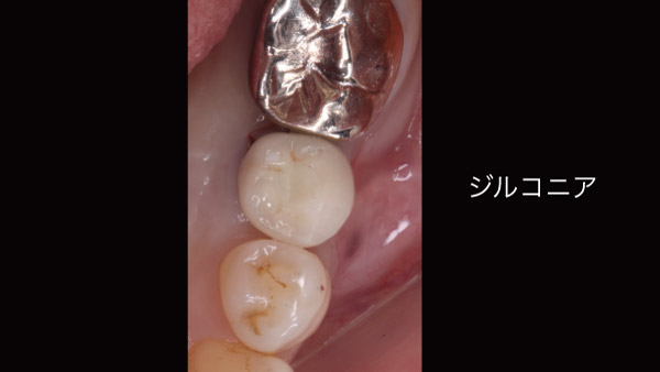 Ⅱ ．下の奥歯を歯根破折で1本失った症例